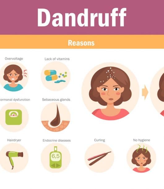Dandruff Cure