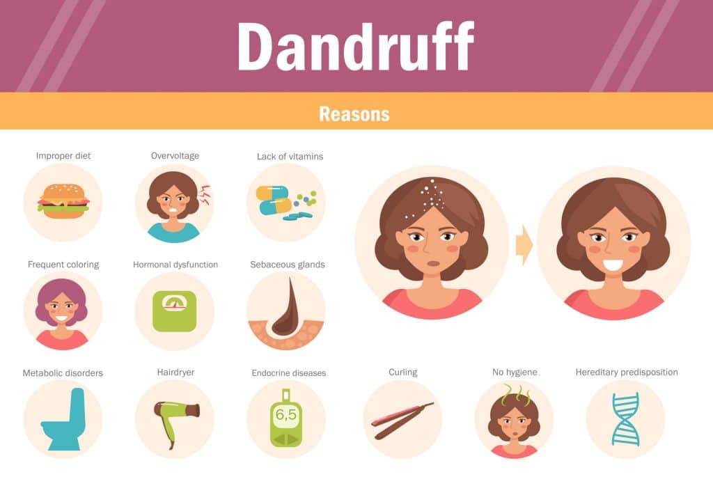 Dandruff Cure Discover Natural Home Remedies Sandra Bloom
