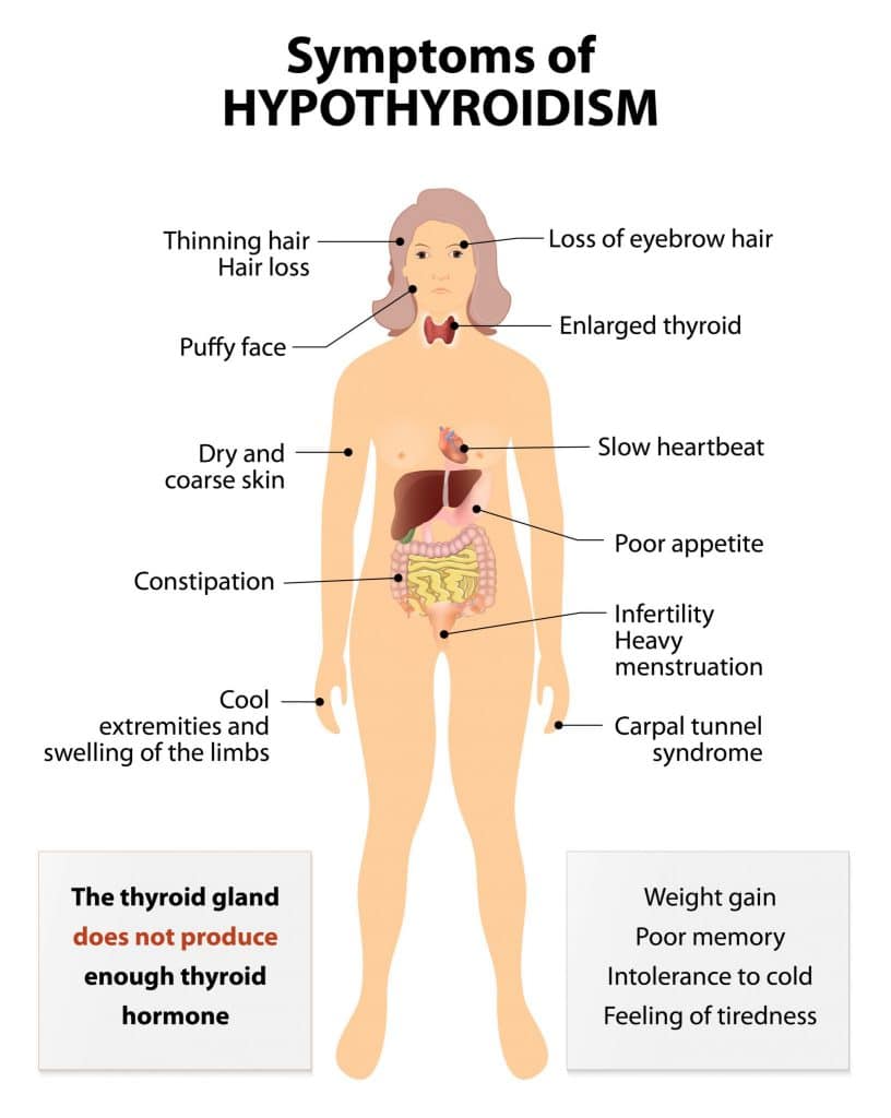 Hypothyroidism: Most Common Hair Loss Cause in Women